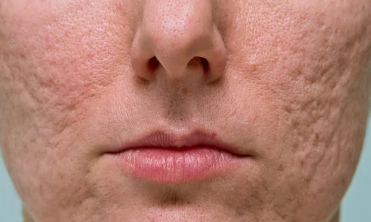 Acne Scar Treatment