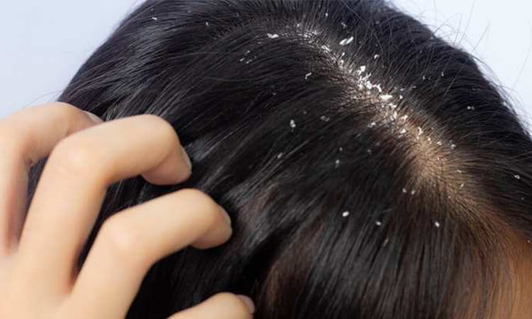Dandruff Treatment