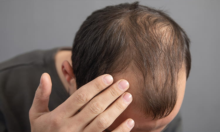 Hair Fall Treatment