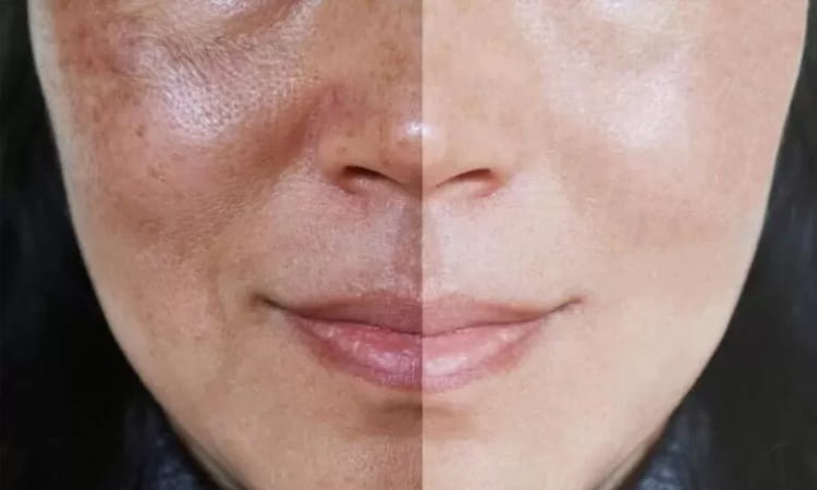 Melasma Treatment