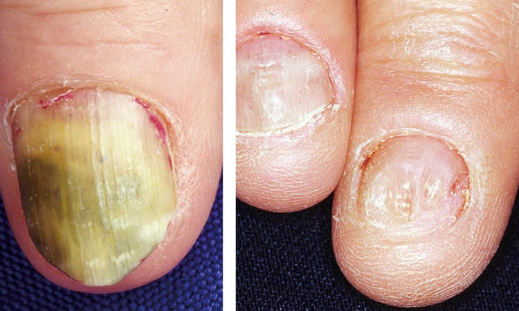 Nail Deformities Treatment