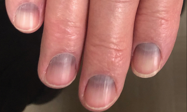 Nail Discolouration Treatment