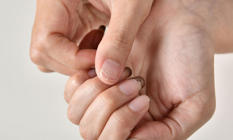 Nail Infection Treatment