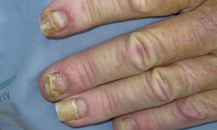 Nail Psoriasis Treatment