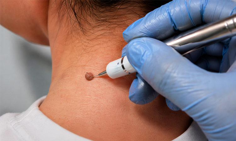 Skin Tag Removal
