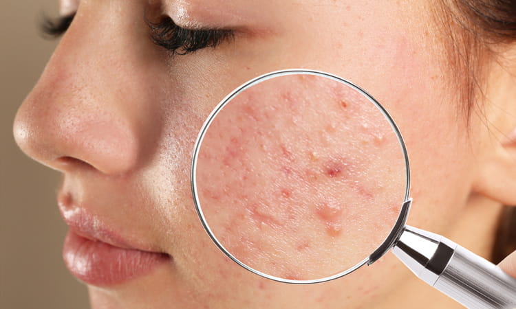 acne treatment