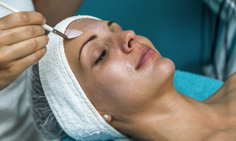 chemical peel treatment